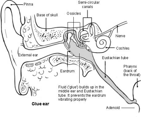 Glue Ear –Conductive Hearing Loss - Family Hub